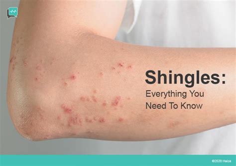 What Are Shingles Halza