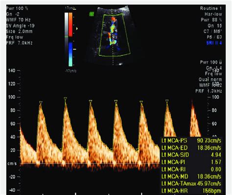 Elevated Peak Systolic Velocity Seen In Middle Cerebral Artery Doppler