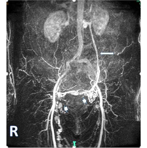 Mrimrv The Left Ovarian Vein Long Arrow Is Clearly Identified
