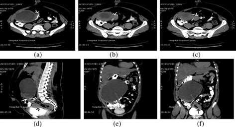 Ovarian Cystadenoma With Torsion Axial A C Sagittal Reformatted D Download Scientific