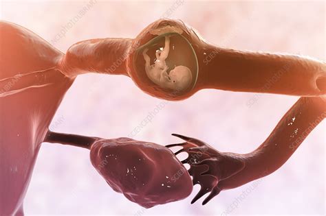 Ectopic Pregnancy Illustration Stock Image F0347687 Science