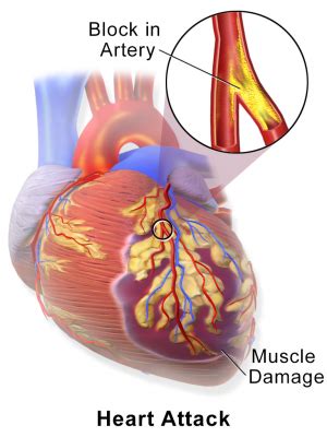 Half of STEMI heart attack patients may have additional clogged arteries