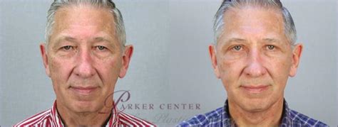 Facelift Before And After Photo Gallery Paramus New Jersey Parker Center For Plastic Surgery