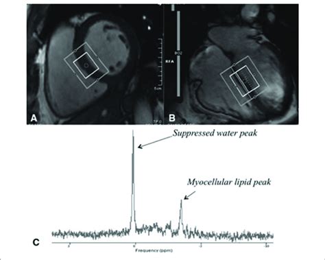 Assessment Of Myocardial Steatosis Using Cardiac Proton Magnetic