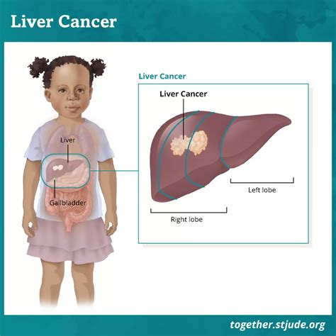 Liver Cancer Types And Stages