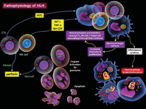 What Is Hlh Disease Pathology Outlines Diseases Club Center