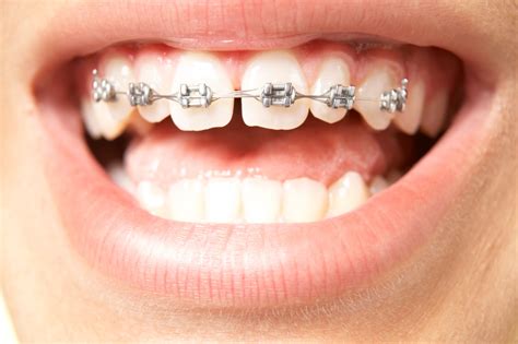 Blog by Orthodontist Nancy Phan, DDS, MS: Does my child need early ... 