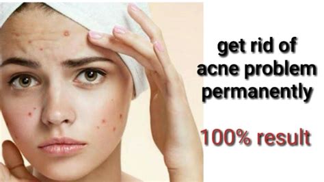 Remove Pimples Permanently Get Glowing And Acne Free Skin Naturally Get Rid Of Acne Problem