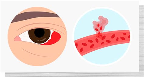 subconjunctival hemorrhage treatment  family vision care  richmond
