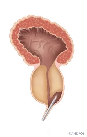 TURP Operatie Of Laseren Bij Vergrote Prostaat Andros Clinics