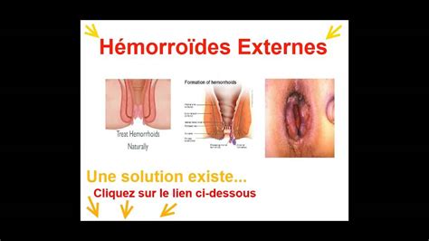 Hemorroide Externe Traitement Youtube