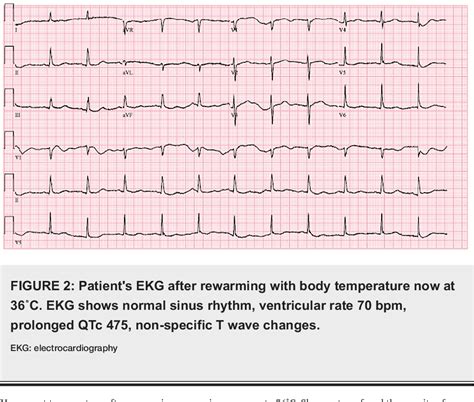 Figure From A Rare Case Of Hypothermia Induced St Segment Elevation