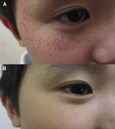 Periorbital Exercise-Induced Purpura - The Journal of Pediatrics