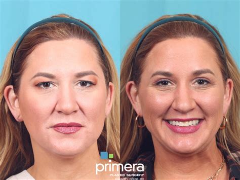 Brow Lift Before And After Pictures Case Orlando Florida