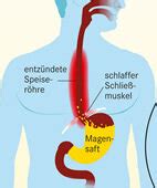 Stiller Reflux Magensaft Im Rachen Apotheken Umschau