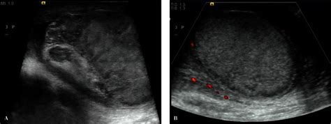 standards  scrotal ultrasonography pmc