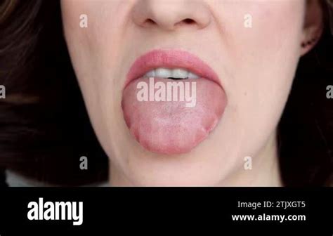 Close-up swelling of the tongue. Allergic reactions, Infections, Angioedema, Trauma or injury ...