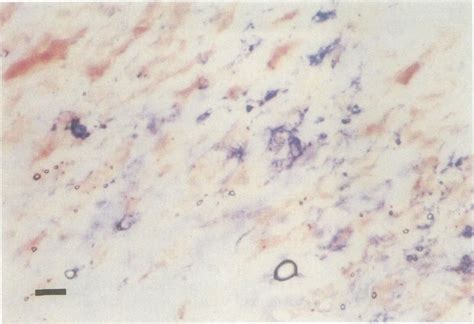 Palisading cells in a rheumatoid nodule double labelledfor non-specific ...