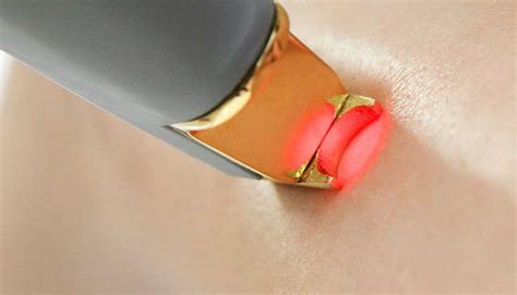 Лазерная эпиляция