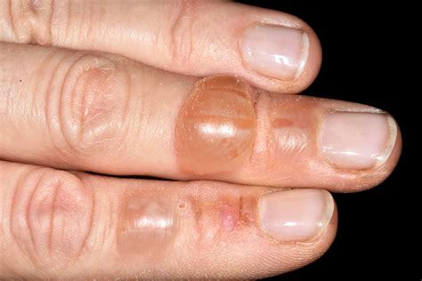 Blisters On Hands And Lips