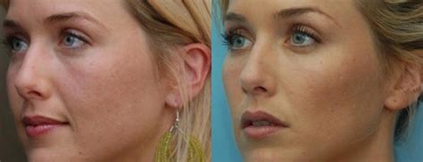 Nasolabial Folds Filler Melbourne Olskin Cosmetic Clinic