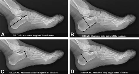 Lateral View Measurements Of The Calcaneus Download Scientific Diagram