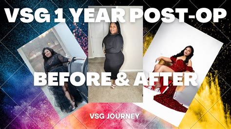 VSG 1 Year Post Op Before After Transformation My VSG Weightloss