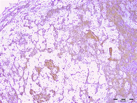 Immunohistochemical Expression Of Syndecan 1 In Pleomorphic Adenoma