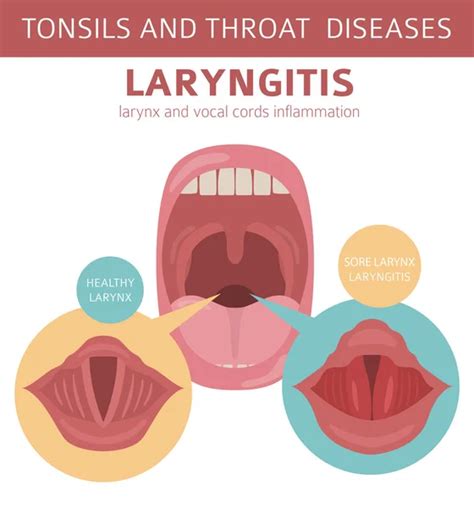 Tonsils Throat Diseases Pharyngitis Symptoms Treatment Icon Set Medical ...