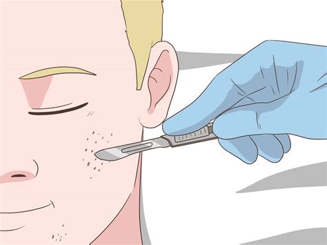 how to get rid of face cysts