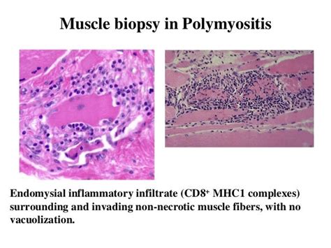 Inflammatory Myopathies