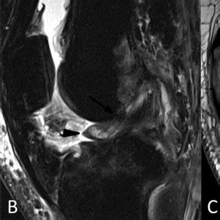 (PDF) Case Series: Cyclops lesion - extension loss after ACL reconstruction