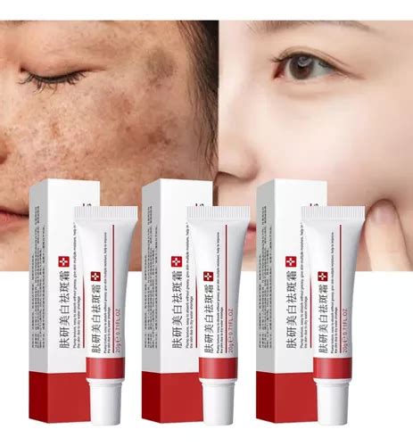 Pomada Para Melasma Farmácia - 3x Incrivel Creme Pomada Para Tirar Manchas, Melasma Espi ...