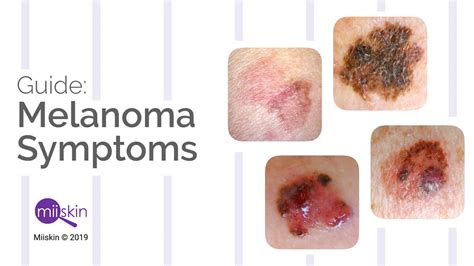 Melanoma Pictures