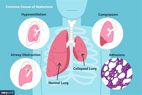 Causes And Treatment Of Atelectasis Collapsed Lung