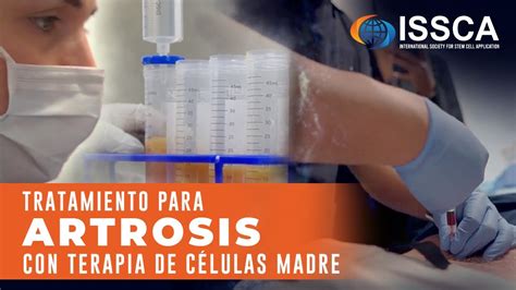 Tratamiento Para Artrosis Con Terapia De C Lulas Madre Youtube