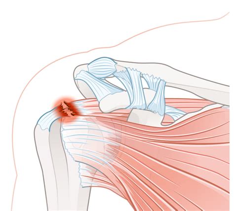 Rotator Cuff Tear - Symptoms and Treatments - Total Spine