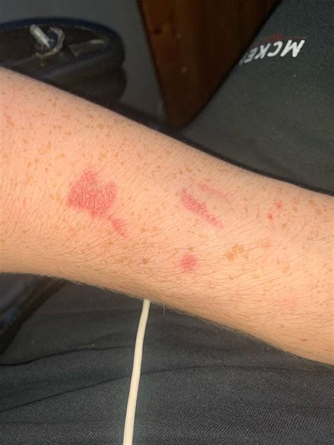 My Scar Tattoo It Glows Under Black Light Rscars