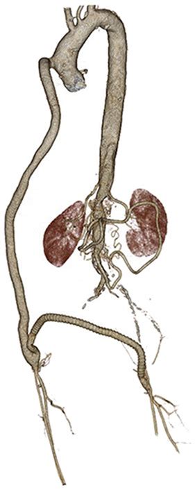 Cardiac Surgery Combined With Bypass From The Ascending Aorta To The Bilateral Femoral Arteries