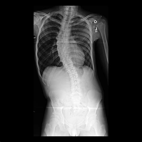 scoliosis | pacs