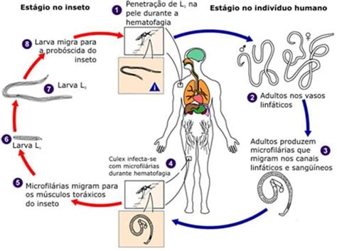 Elefantiase O Que É - Enem 2013 - Saiba tudo sobre a Elefantíase para sua prova!