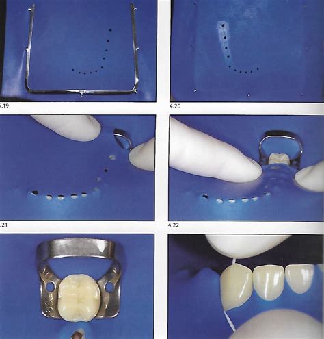 Rubber Dam Isolation In The Posterior Segment Dental Esthetics