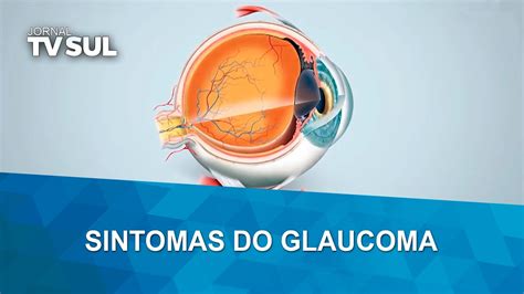 Glaucoma Conheça Os Sintomas E Saiba Como Prevenir Youtube