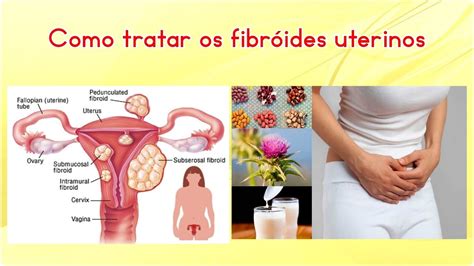 Como Tratar Os Fibróides Uterinos Youtube