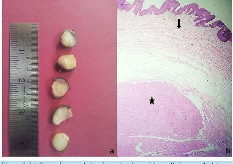 Figure 1 From Intra Scrotal Extra Testicular Leiomyoma A Common