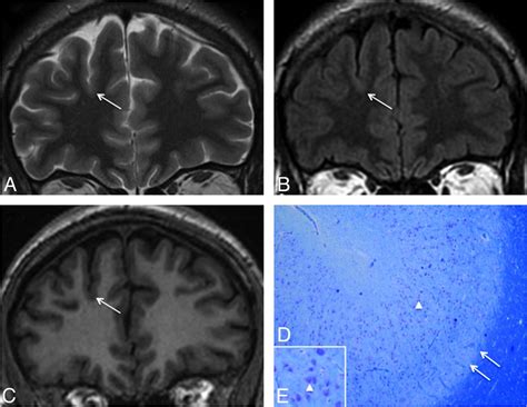 Optimizing Mr Imaging Detection Of Type Focal Cortical Dysplasia