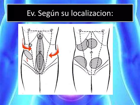 Hernias De La Pared Abdominal Eventracion Y Eviceracion Generalidades Tipos Diagnostico Y