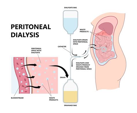 Peritoneal Dialysis in Turkey | 2026 Dialysis Costs