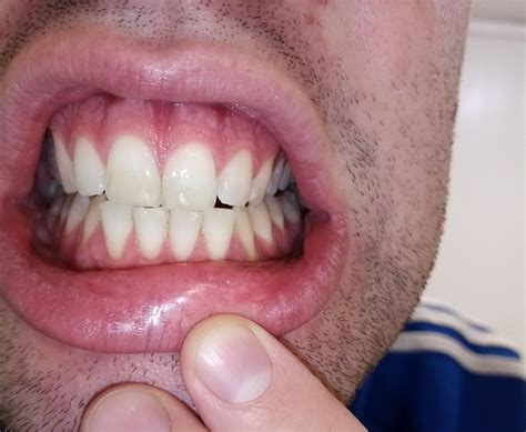 Тёмная полоска на зубе - Вопрос стоматологу - 03 Онлайн