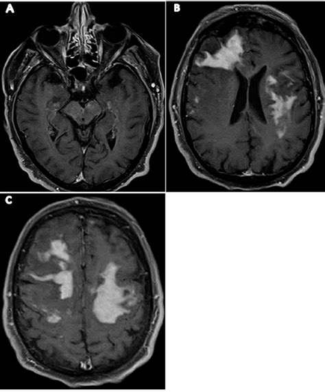 A Axial T2 Flair Magnetic Resonance Imaging Of The Brain Reveals